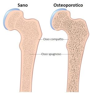 bertarini-Osteoporosi